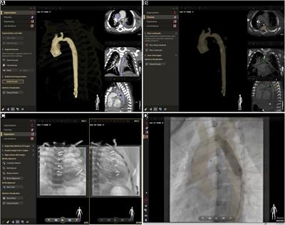 Multimodality 3D image fusion with live fluoroscopy reduces radiation dose during catheterization of congenital heart defects